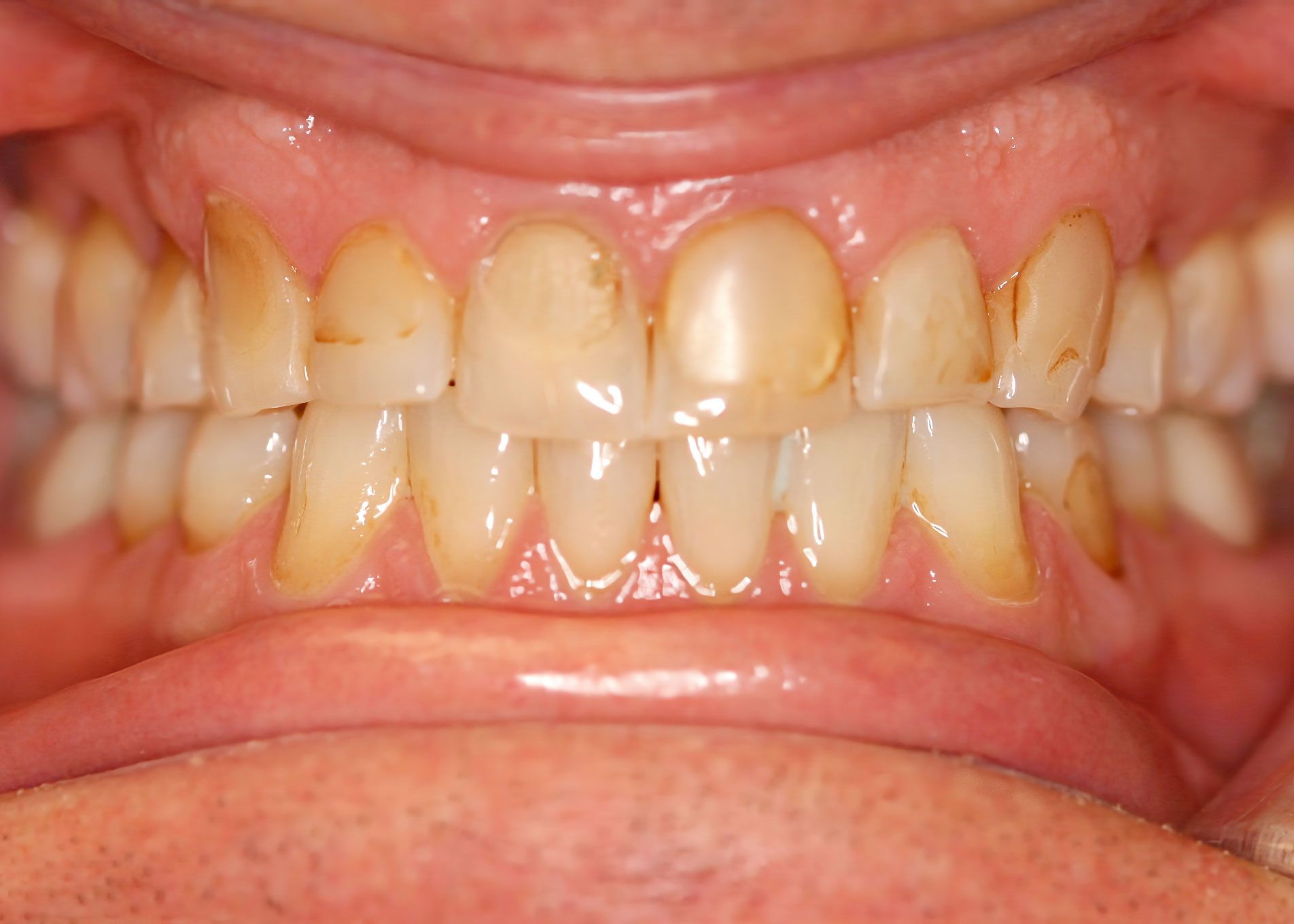 Close-up of teeth, yellowed with some brown spots. The gums are visible and healthy looking.