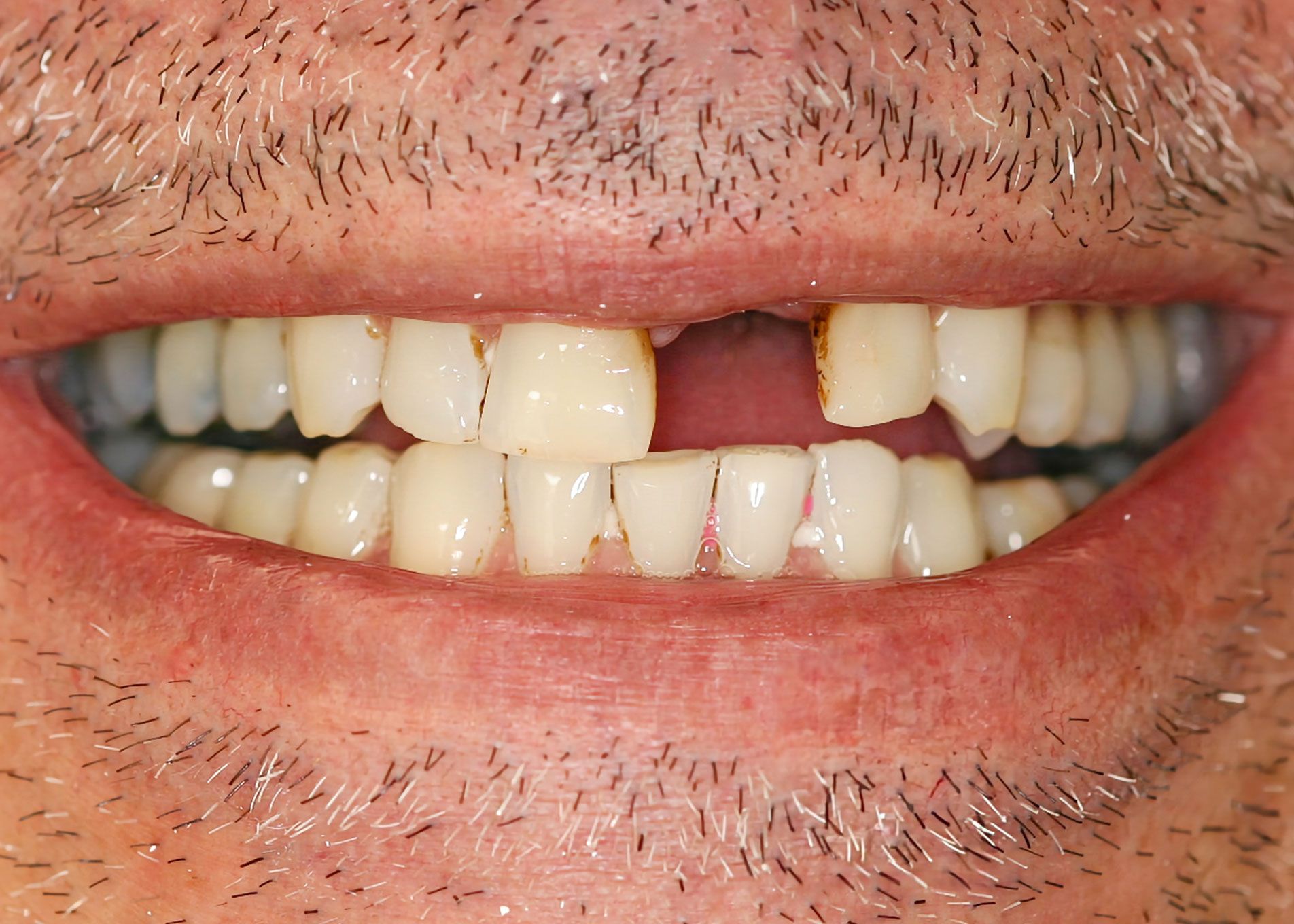 Mouth of a person with a missing front tooth and chipped teeth, smiling.