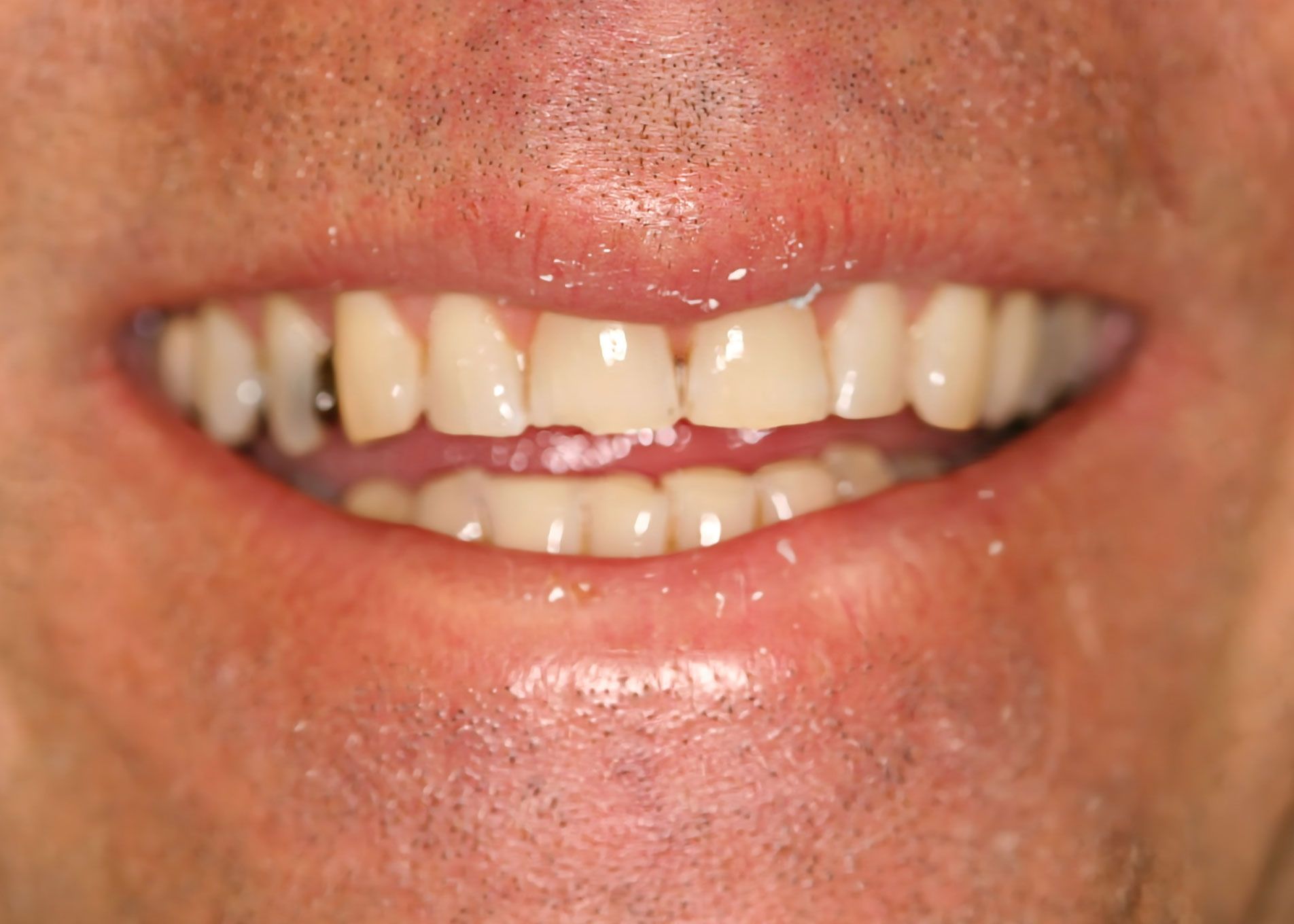 Close-up of a person's smile, showing chipped front teeth.