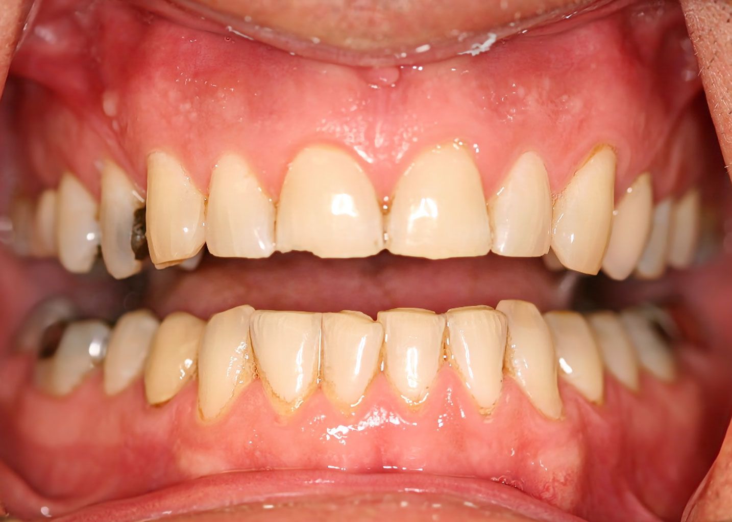 Close-up view of teeth showing yellowing, wear, and minor chips. Gums appear healthy.