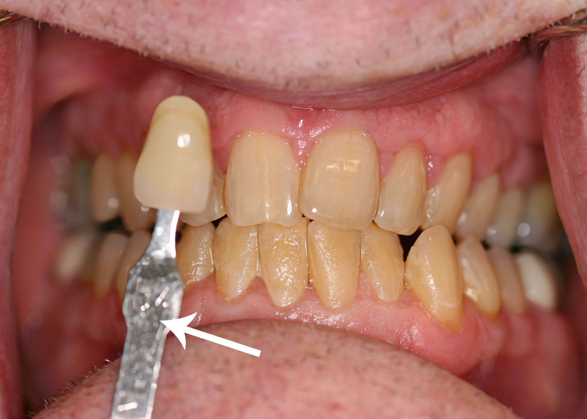 Dental shade guide held next to teeth, showing a color comparison for teeth whitening.