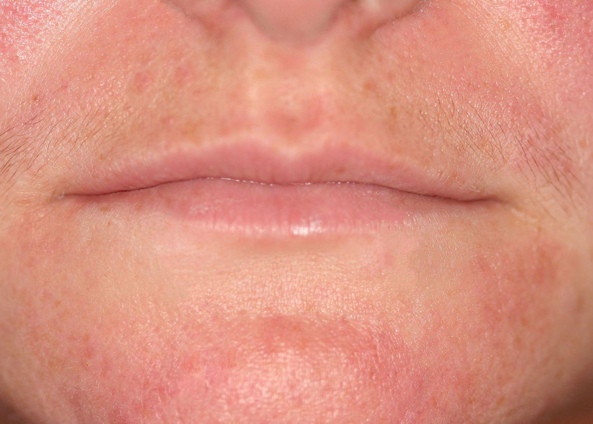 Close-up of human lips and surrounding skin, showing redness and texture.