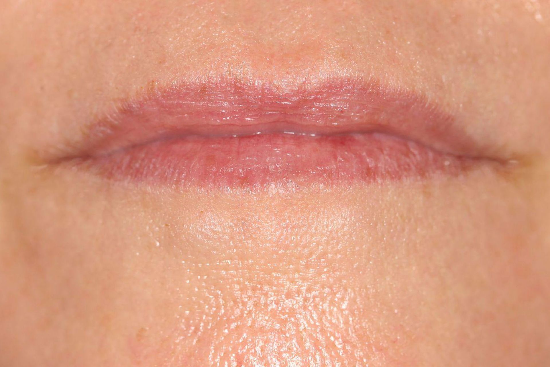 Close-up of human lips and surrounding skin, showing redness and texture.