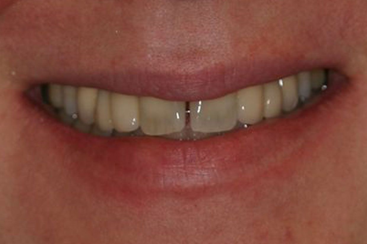 A close-up view of a smiling mouth, showing teeth with a small gap between the two upper central incisors.