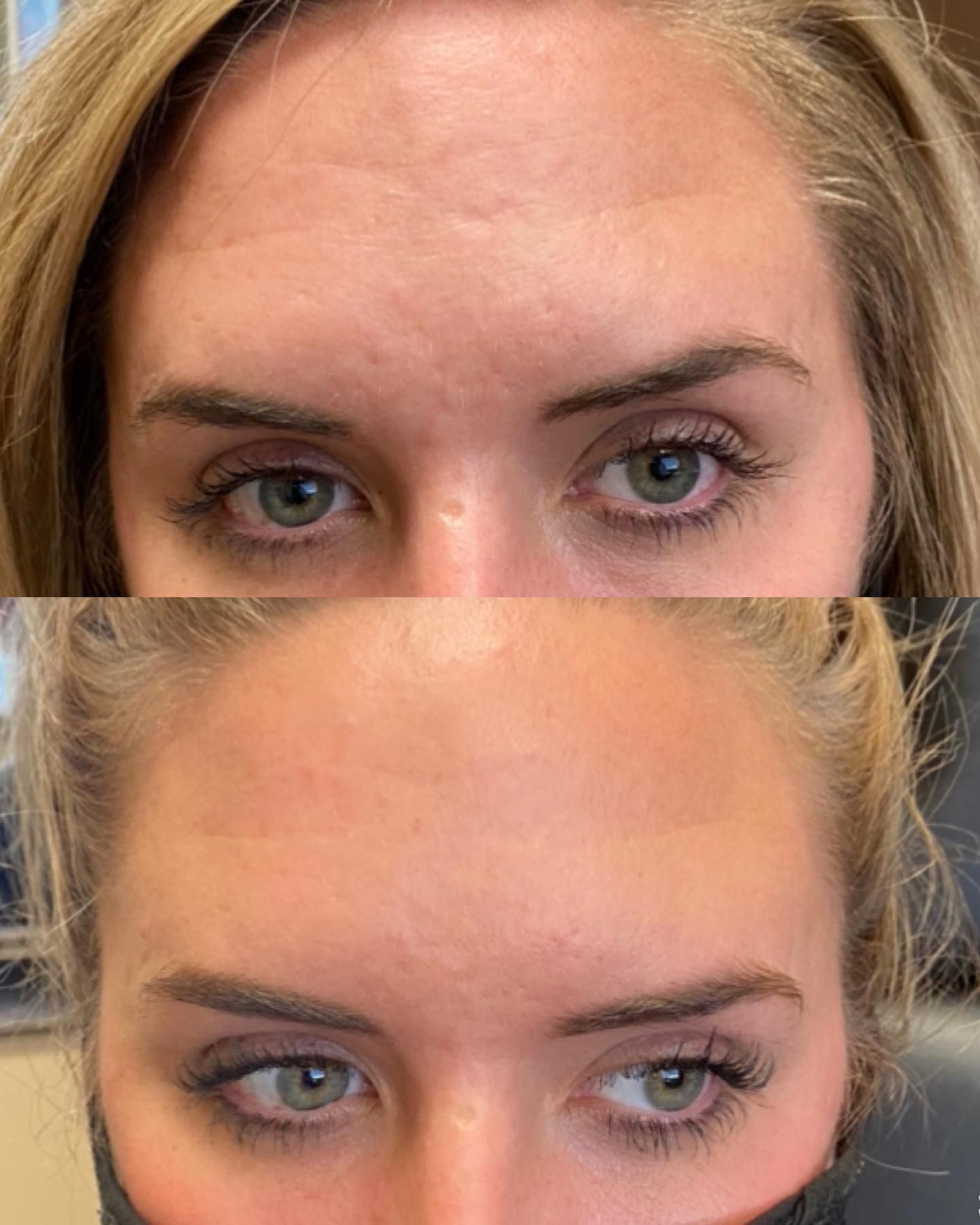 A before and after photo of a woman 's forehead.