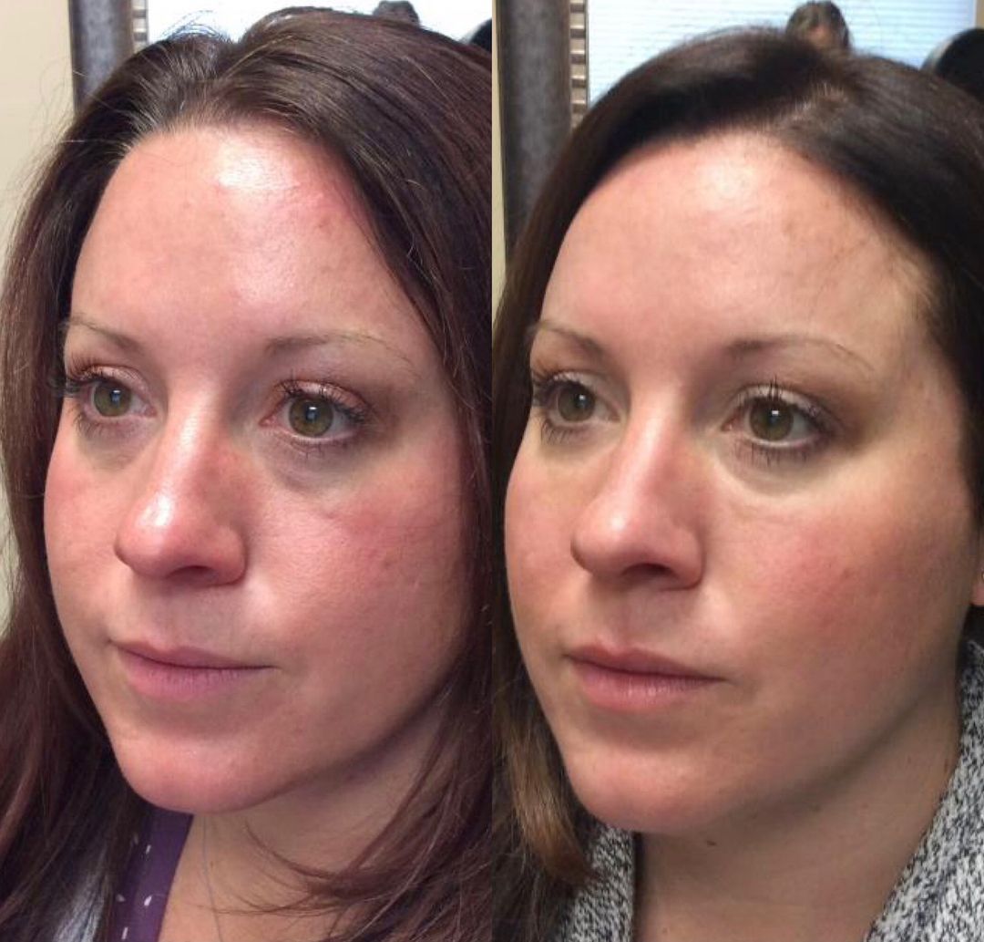 A before and after photo of a woman 's face
