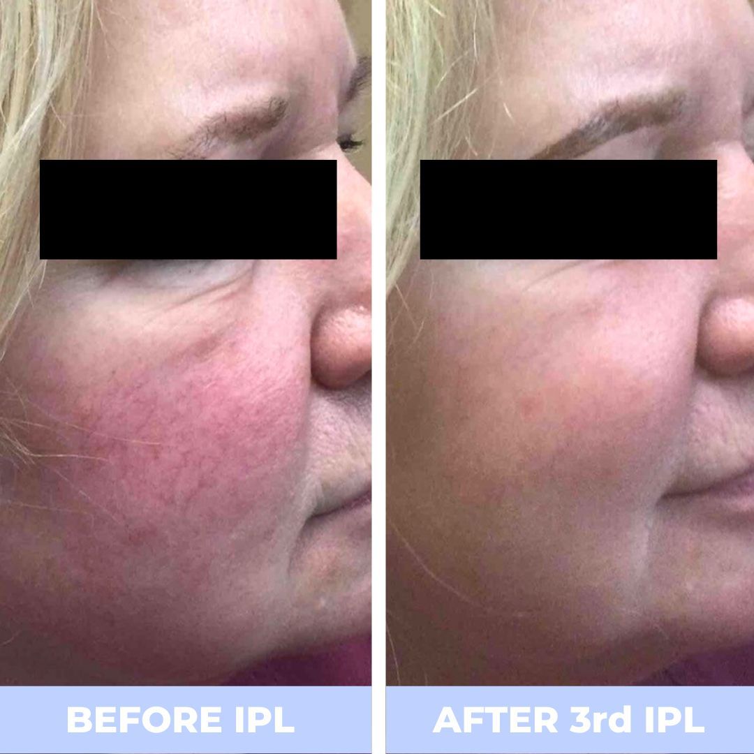 A before and after photo of a woman 's face.