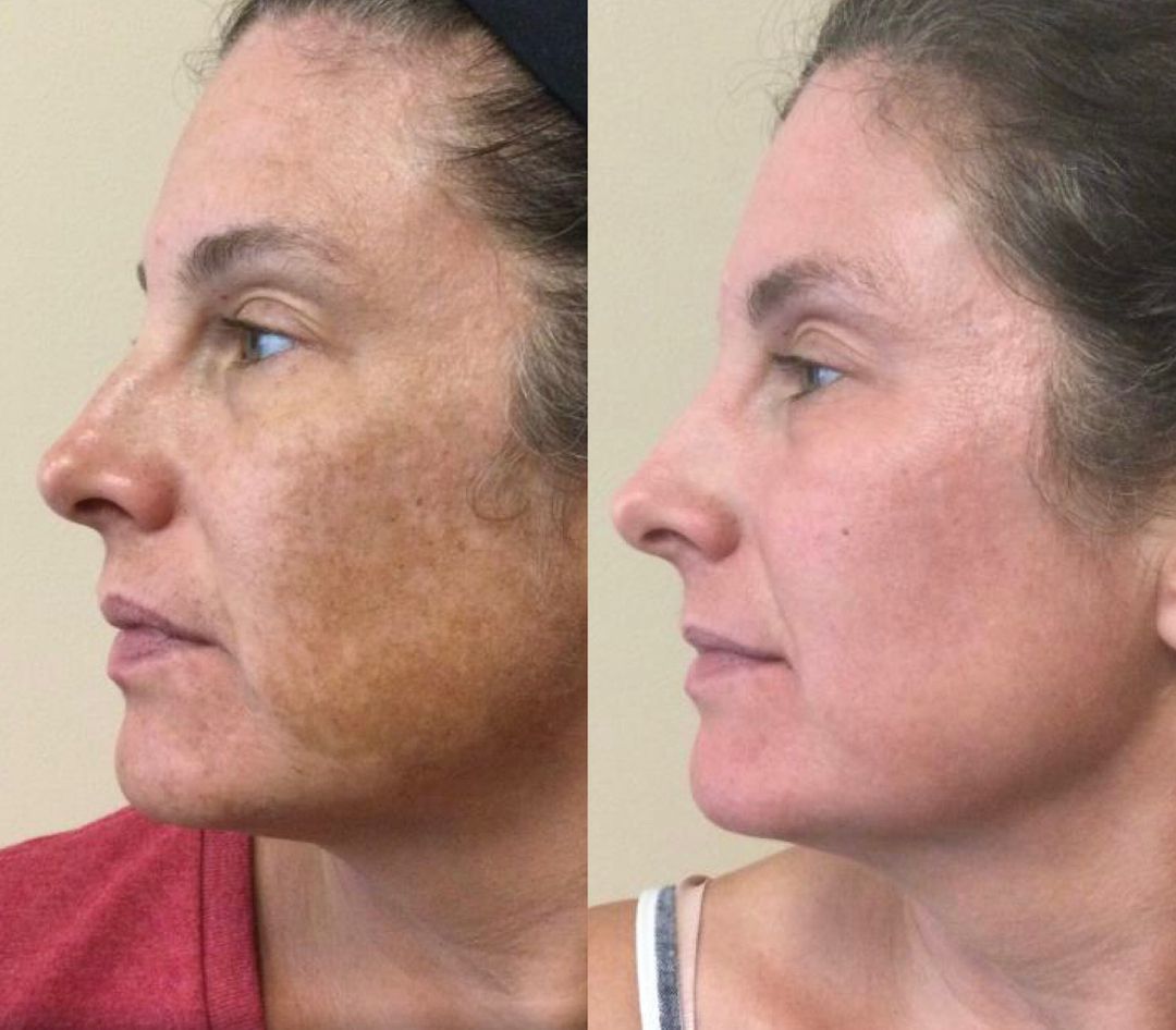 A before and after photo of a woman 's face.