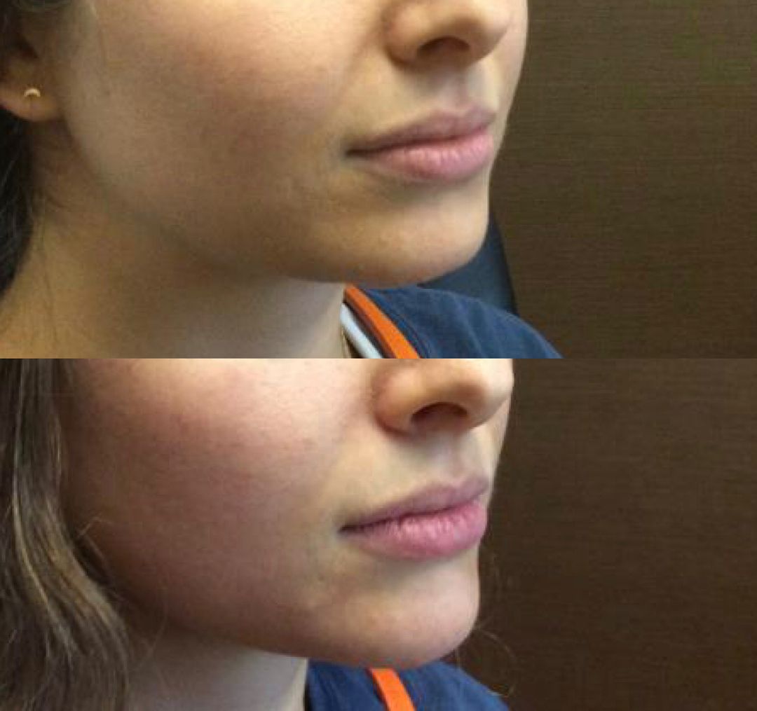 A before and after photo of a woman 's face.