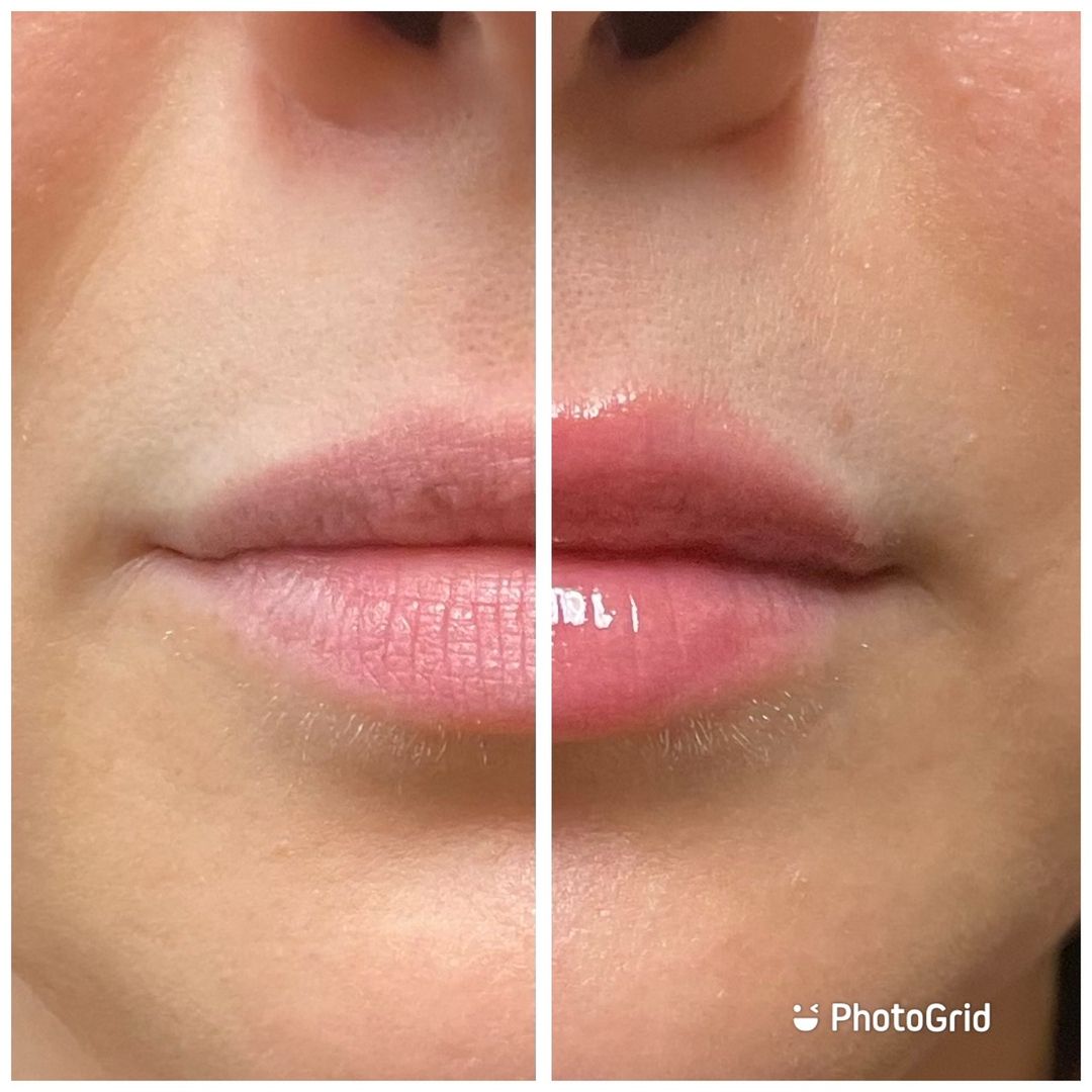 A before and after photo of a woman 's lips.