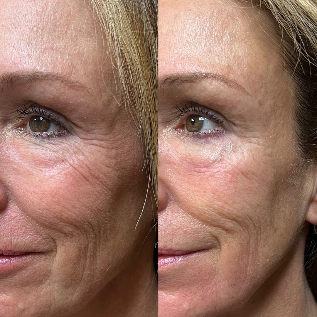 A before and after photo of a woman 's face.