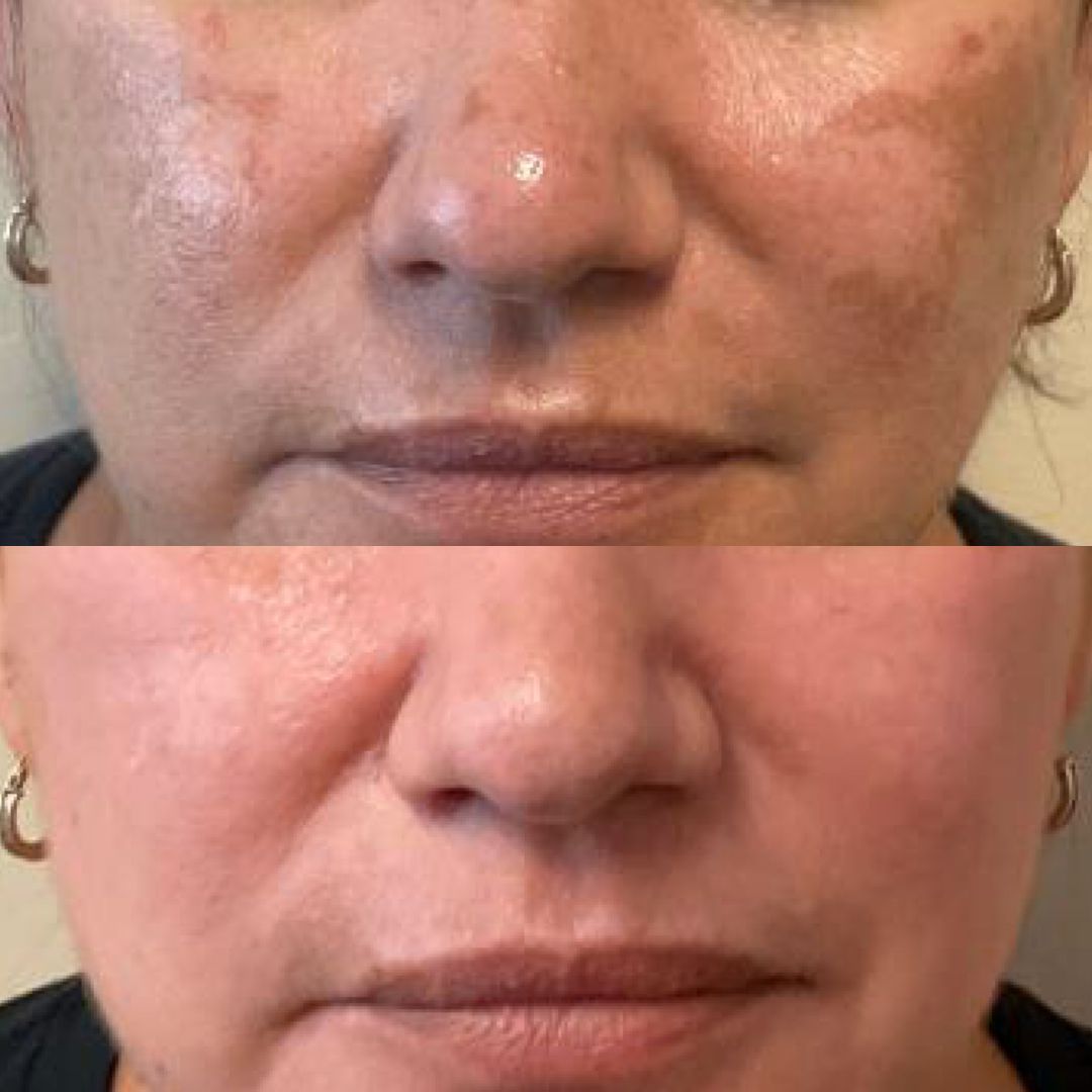 A before and after photo of a woman 's face.