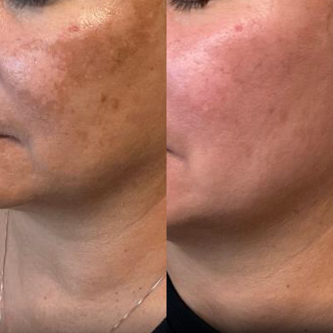 A woman 's face is shown before and after a treatment.