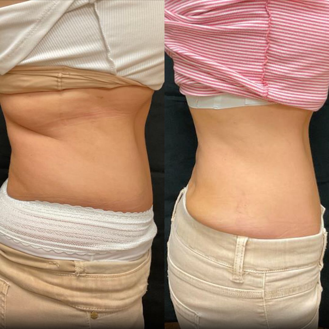 A before and after picture of a woman 's stomach