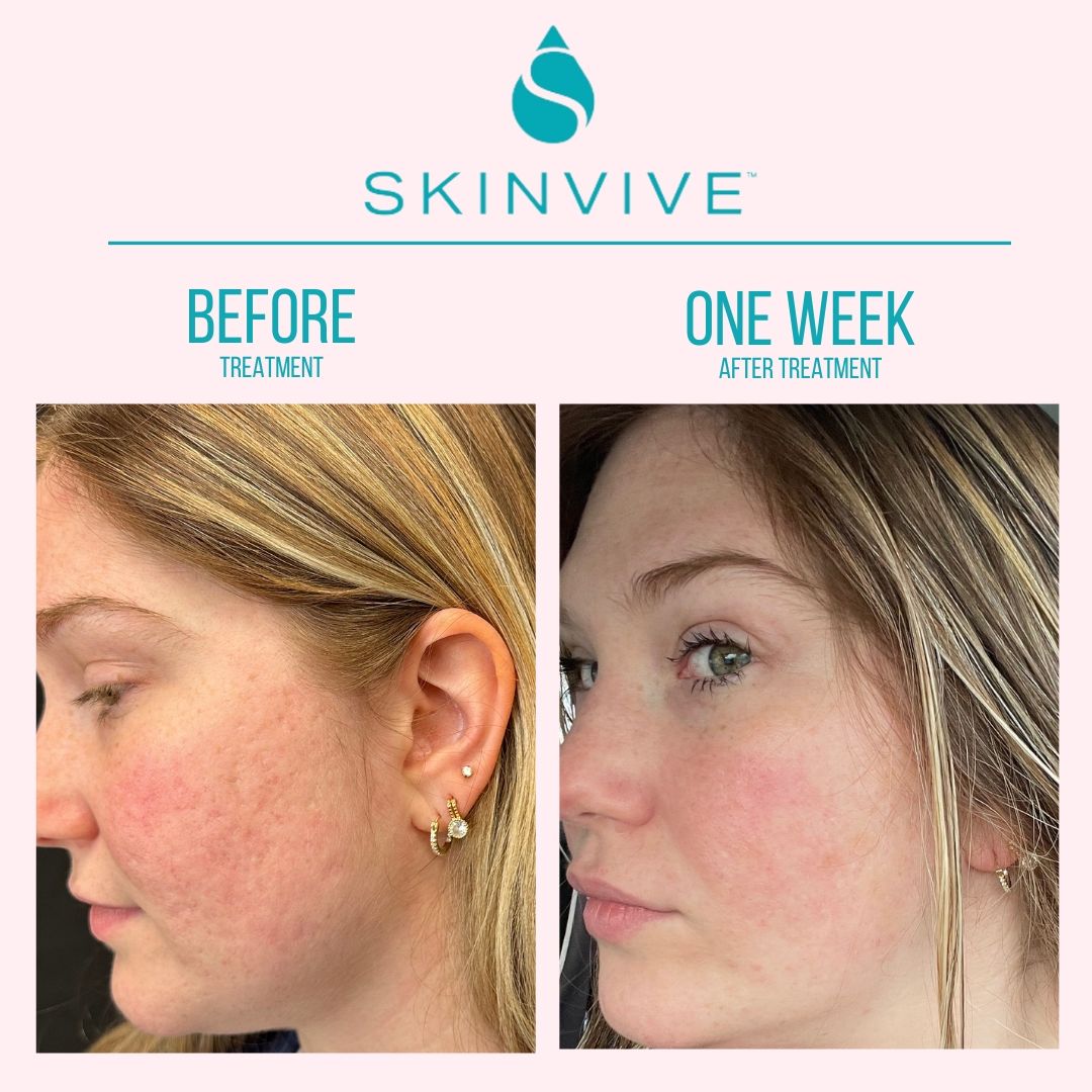 A woman 's face is shown before and after a skinvive treatment