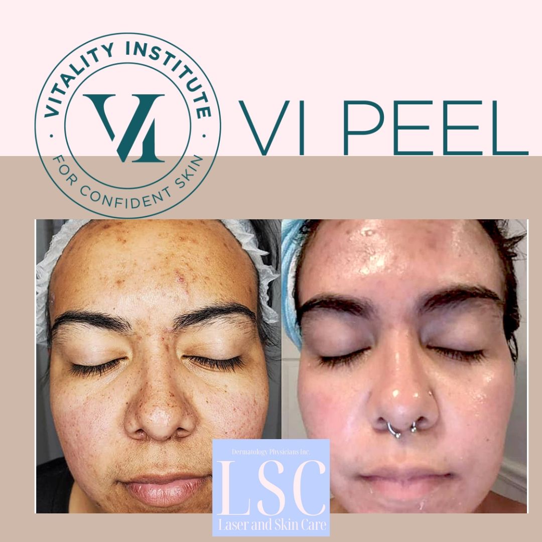 A woman 's face before and after a vi peel treatment.