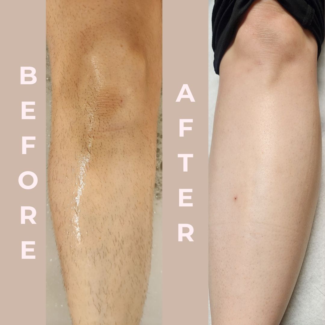 A before and after picture of a woman 's leg with hair.