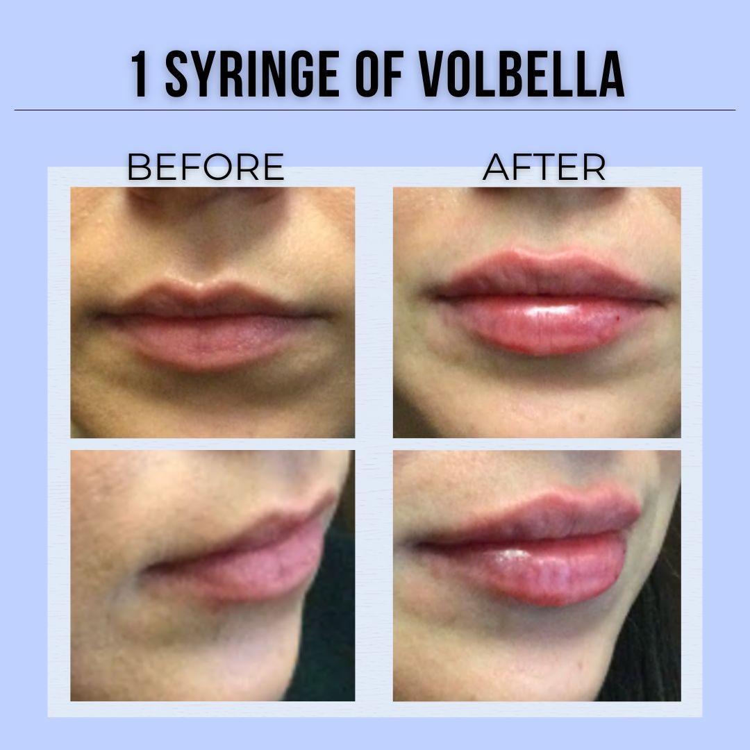 A before and after picture of a woman 's lips with the caption