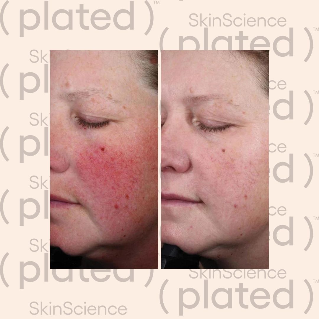 A before and after photo of a woman 's face with redness