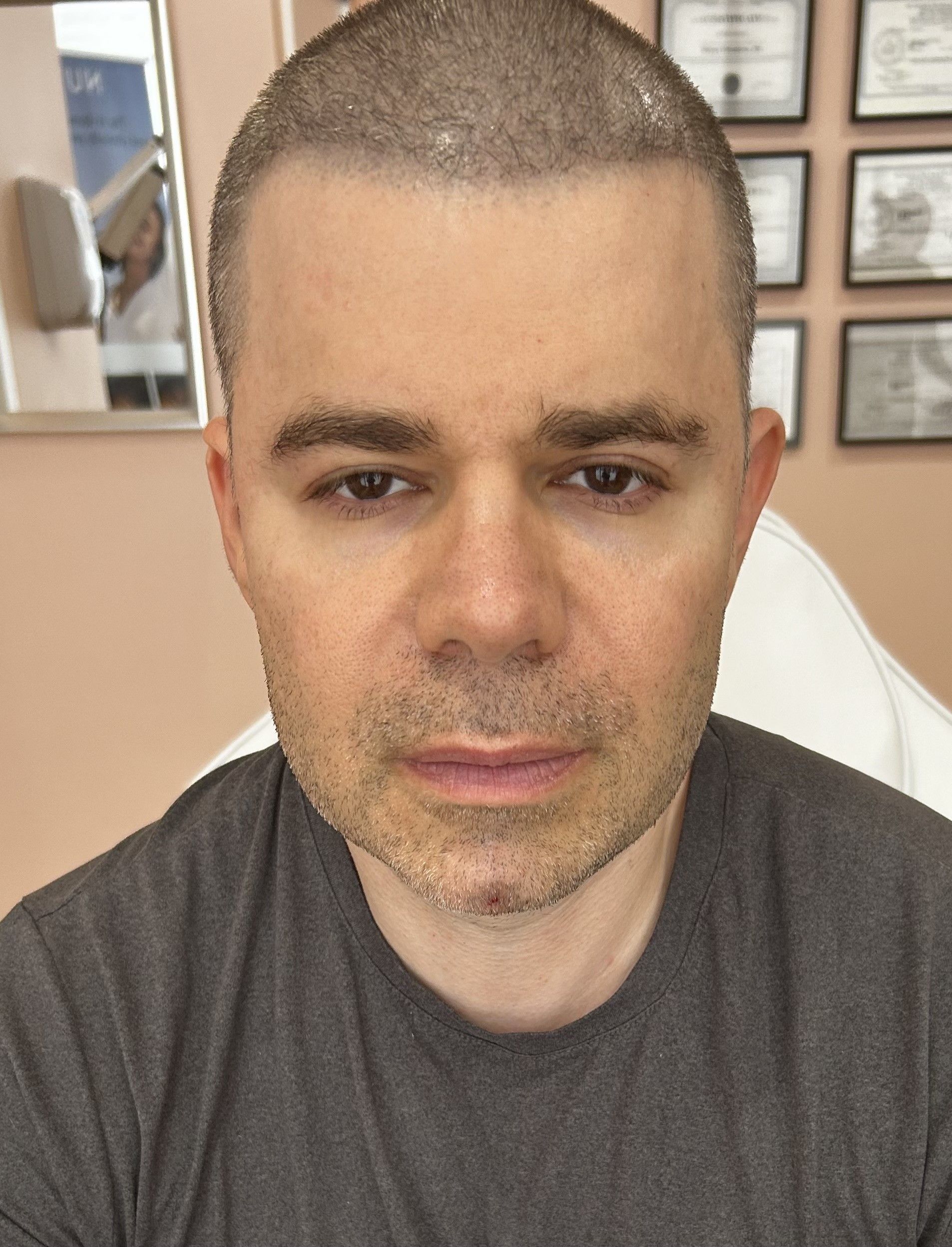 after Sculptra pic