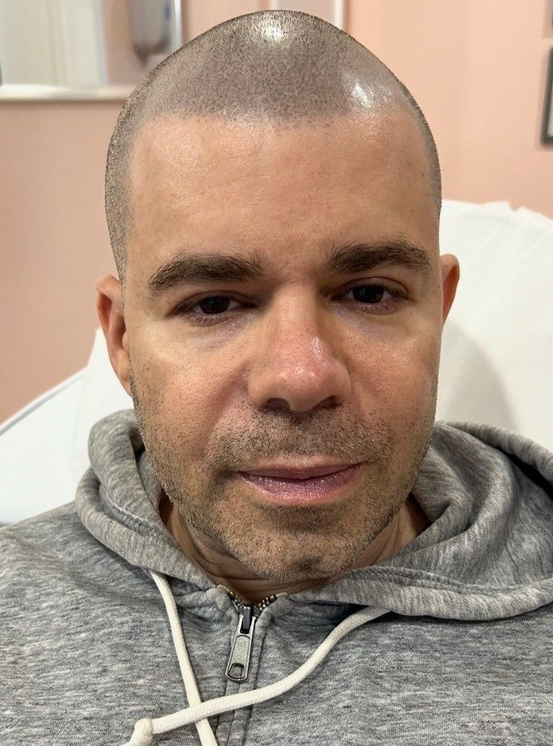 before Sculptra pic