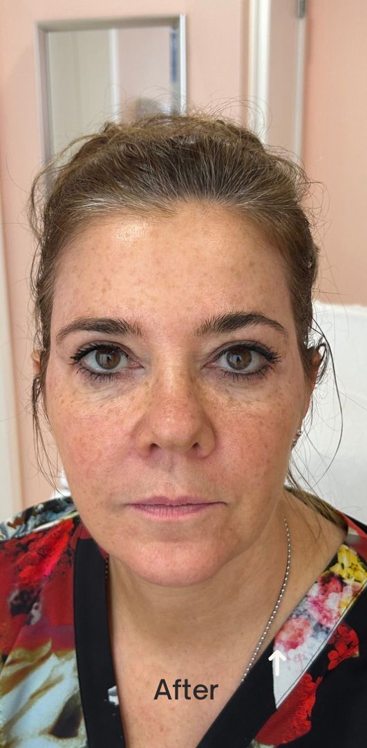 Face of a woman - after treatment