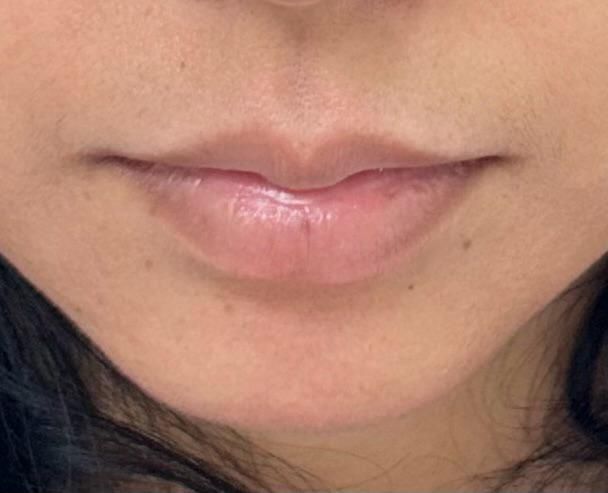 Lip before