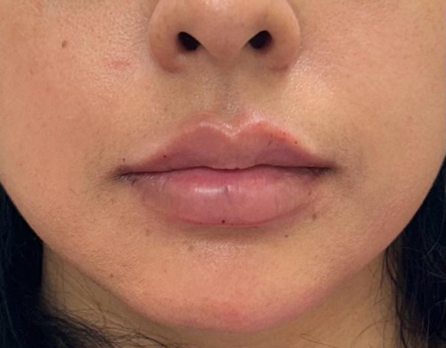 Lip after