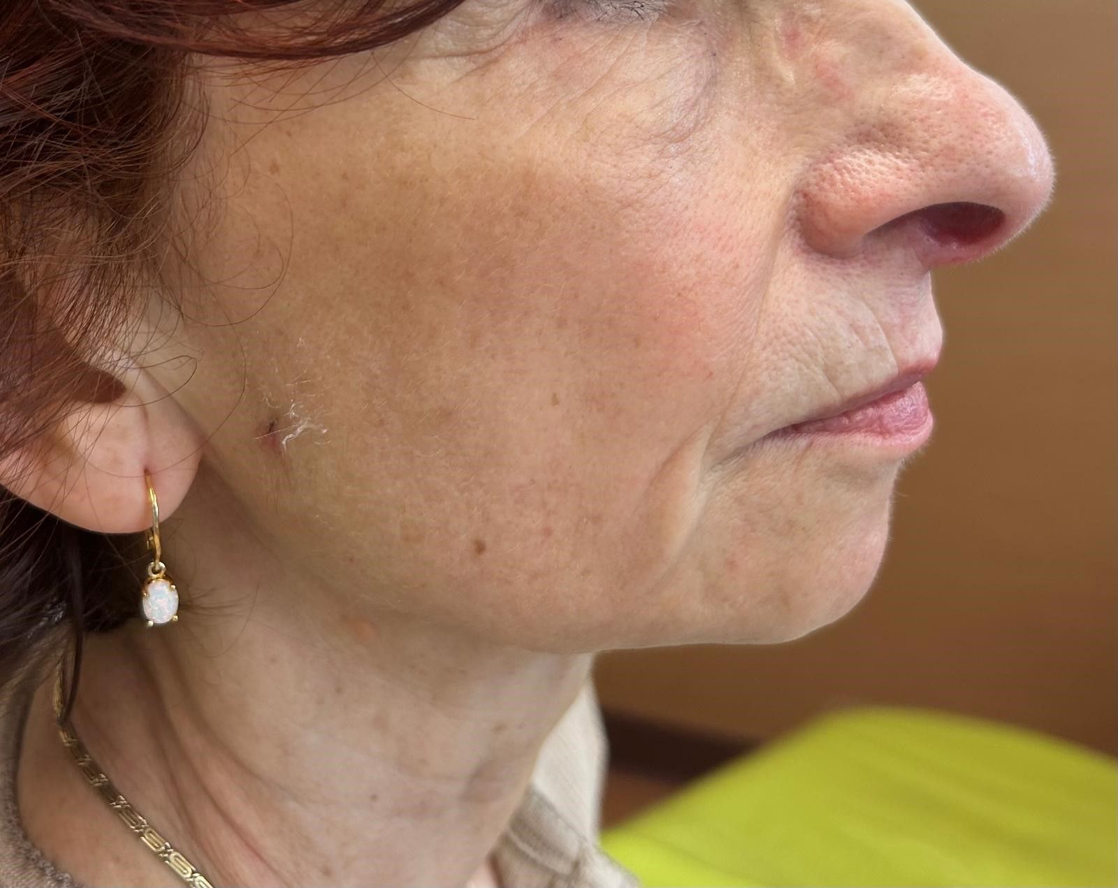 After treatment - right side