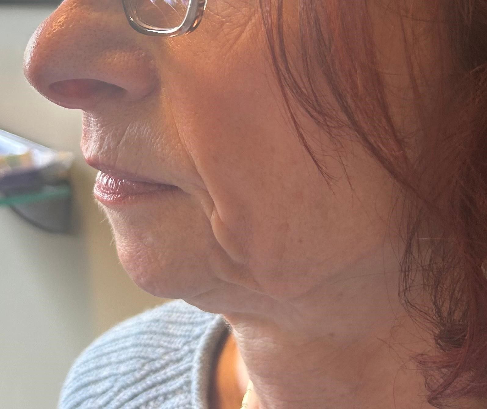 Before treatment - left side