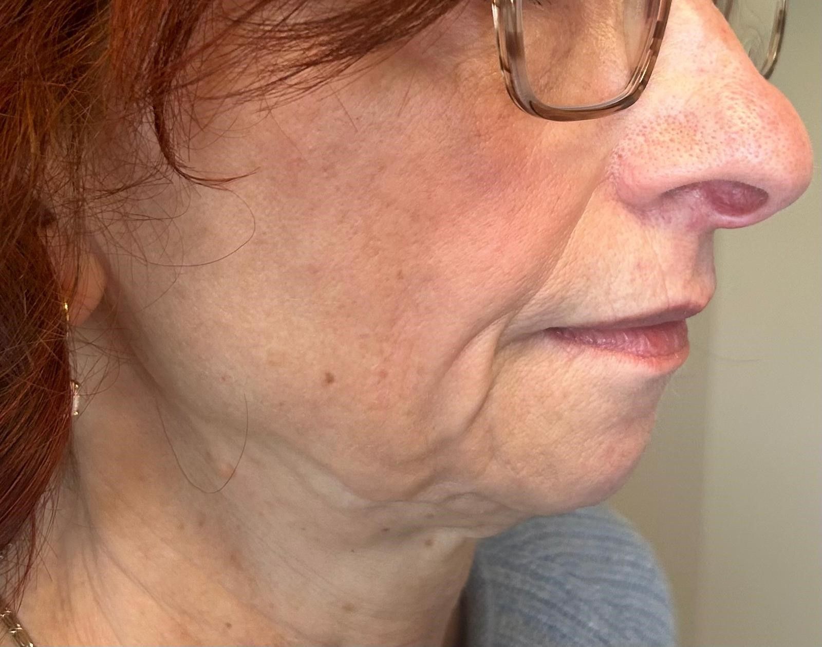 Before treatment - right side