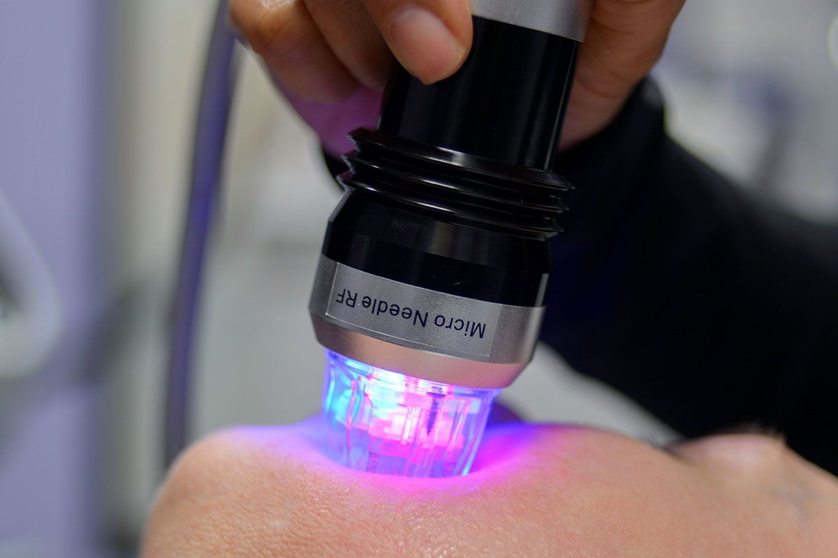 A woman is getting an RF microneedling treatment on her face.