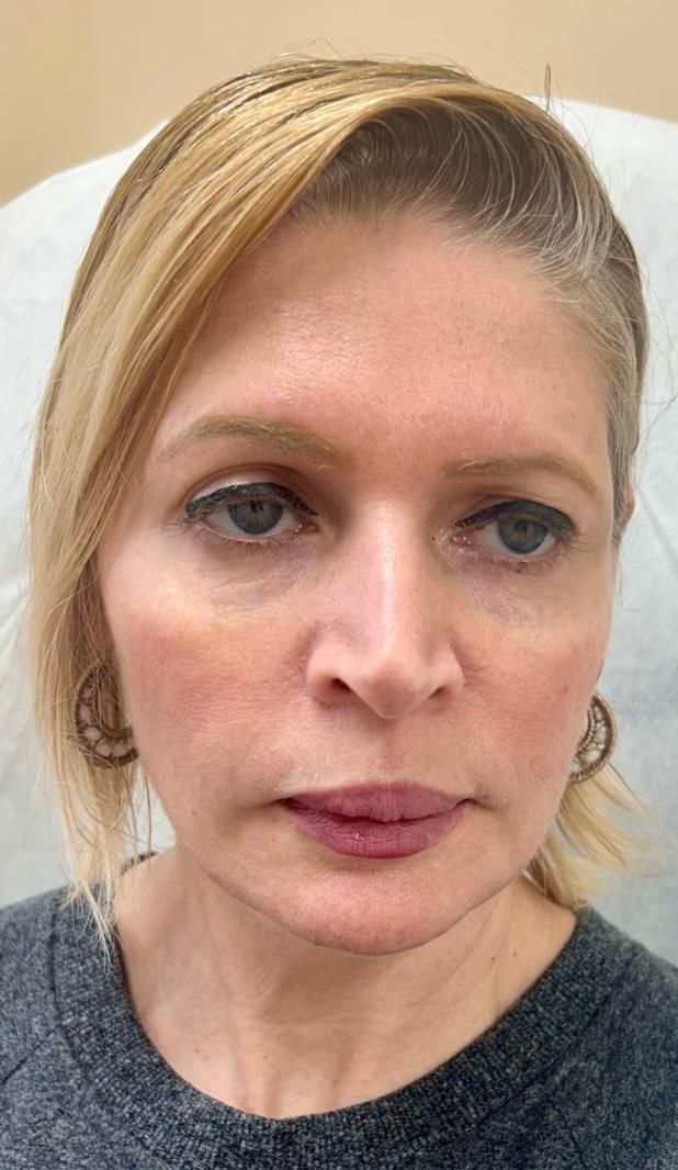 A woman with blonde hair before undergoing aesthetic service