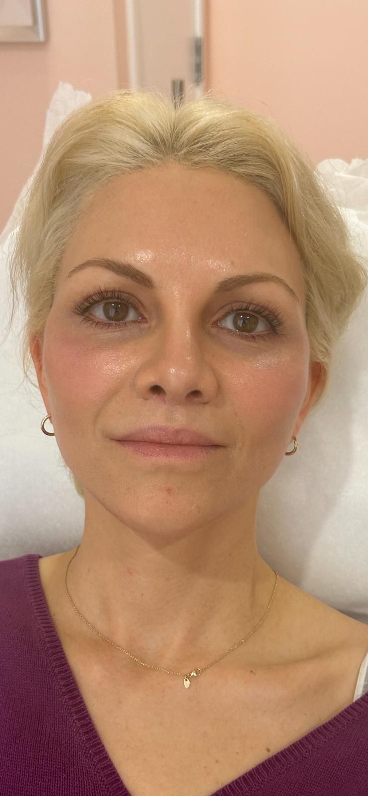 A close up of a woman's face with a purple shirt on after undergoing aesthetic service