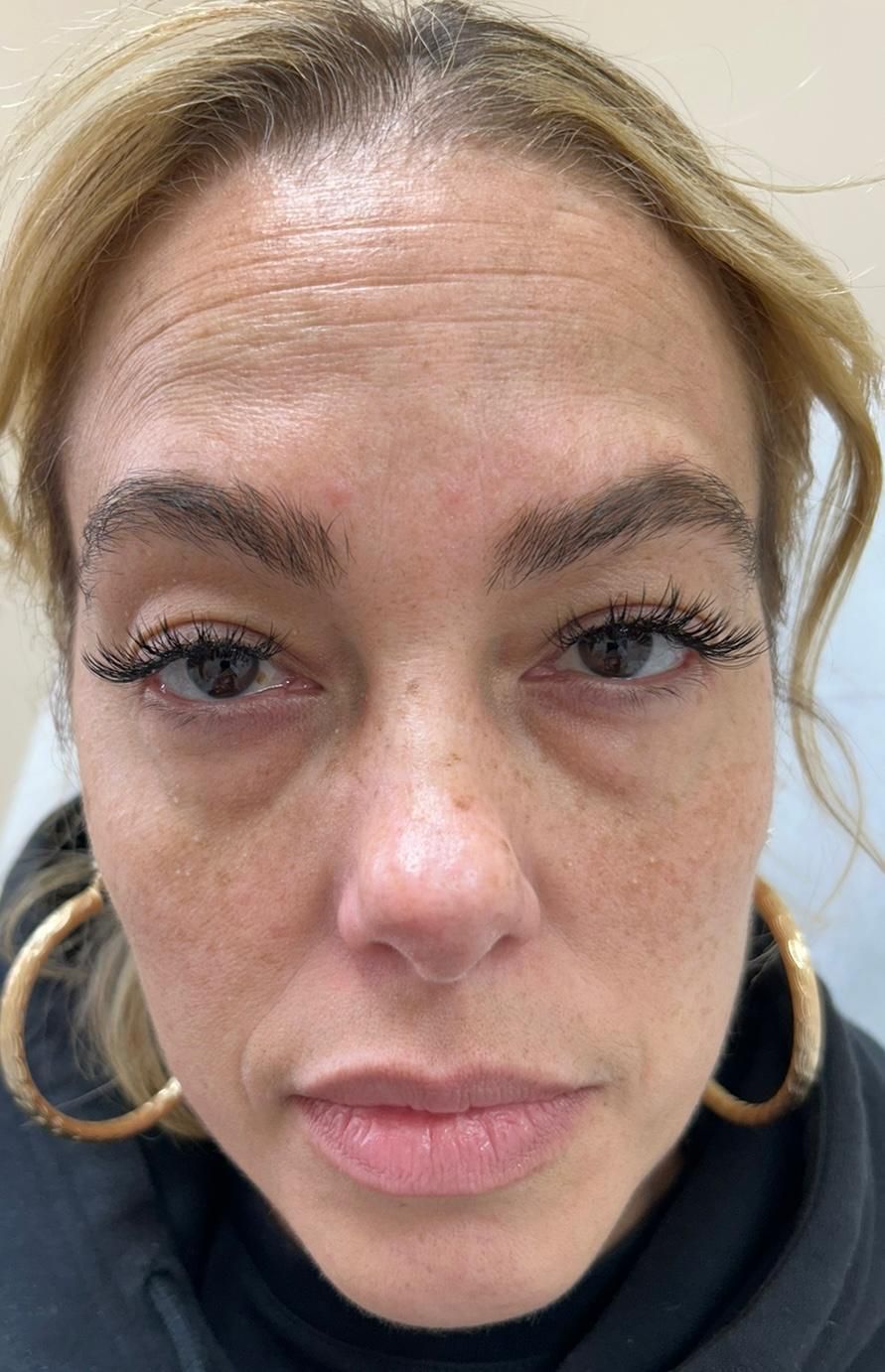 A close up of a woman's face before undergoing aesthetic service