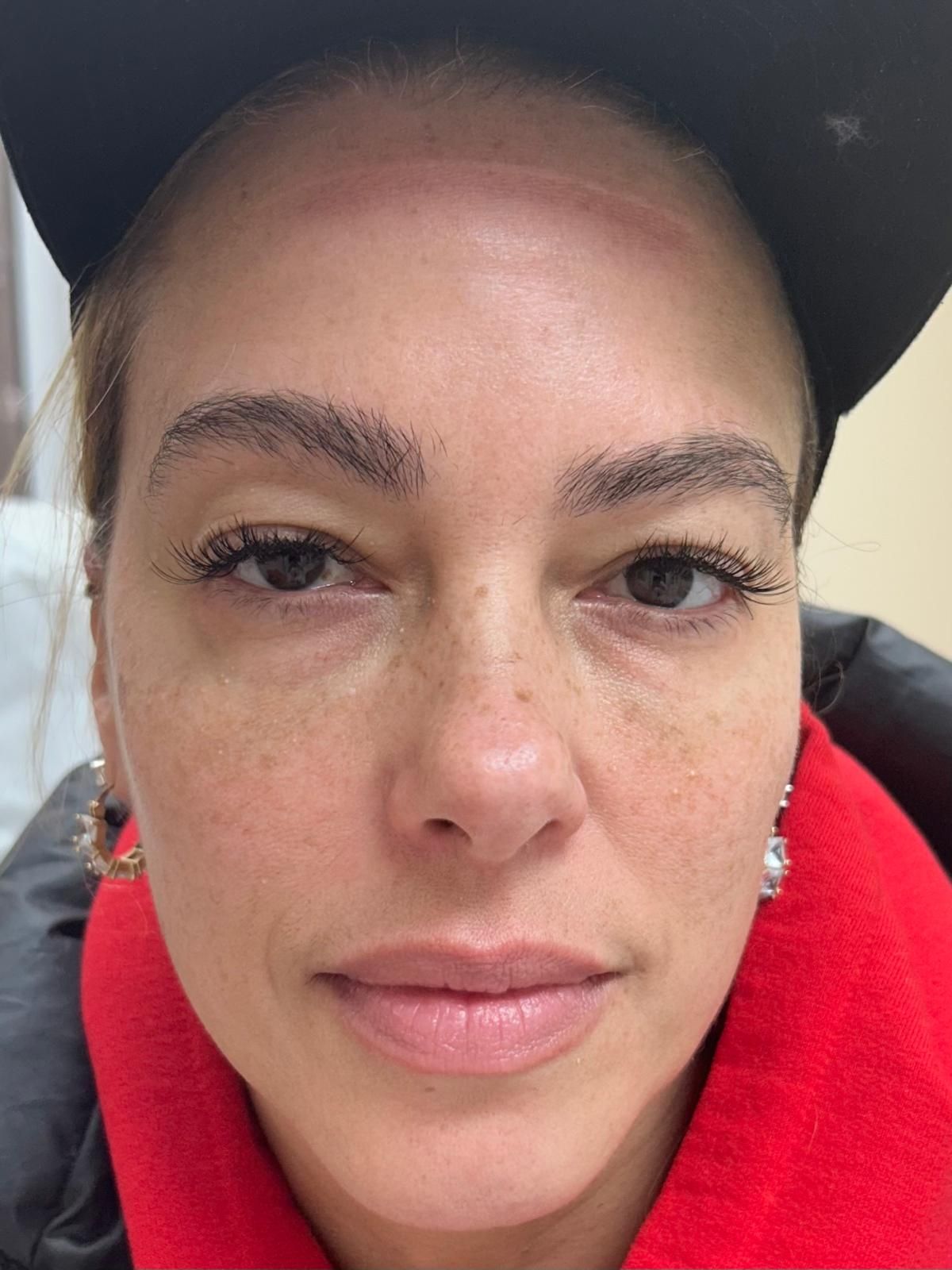 A close up of a woman's face after undergoing aesthetic service