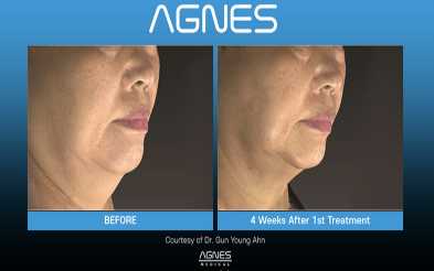 Before and after comparison of a person's jawline and neck area four weeks after an AGNES radiofrequency treatment.