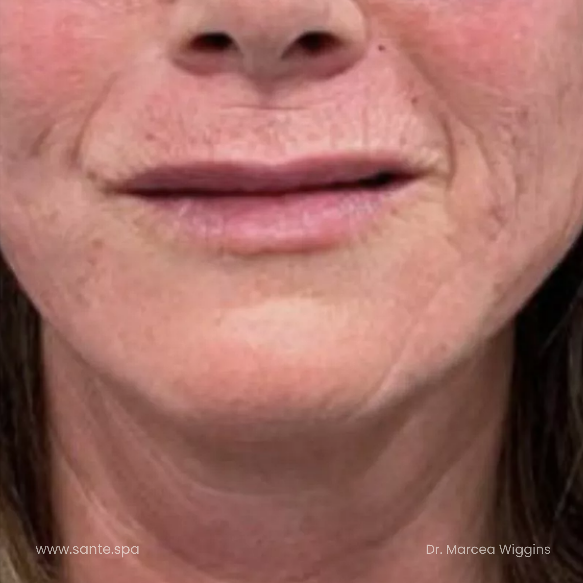 Close-up of a person's lower face showing fine lines around the mouth, chin, and neck area.