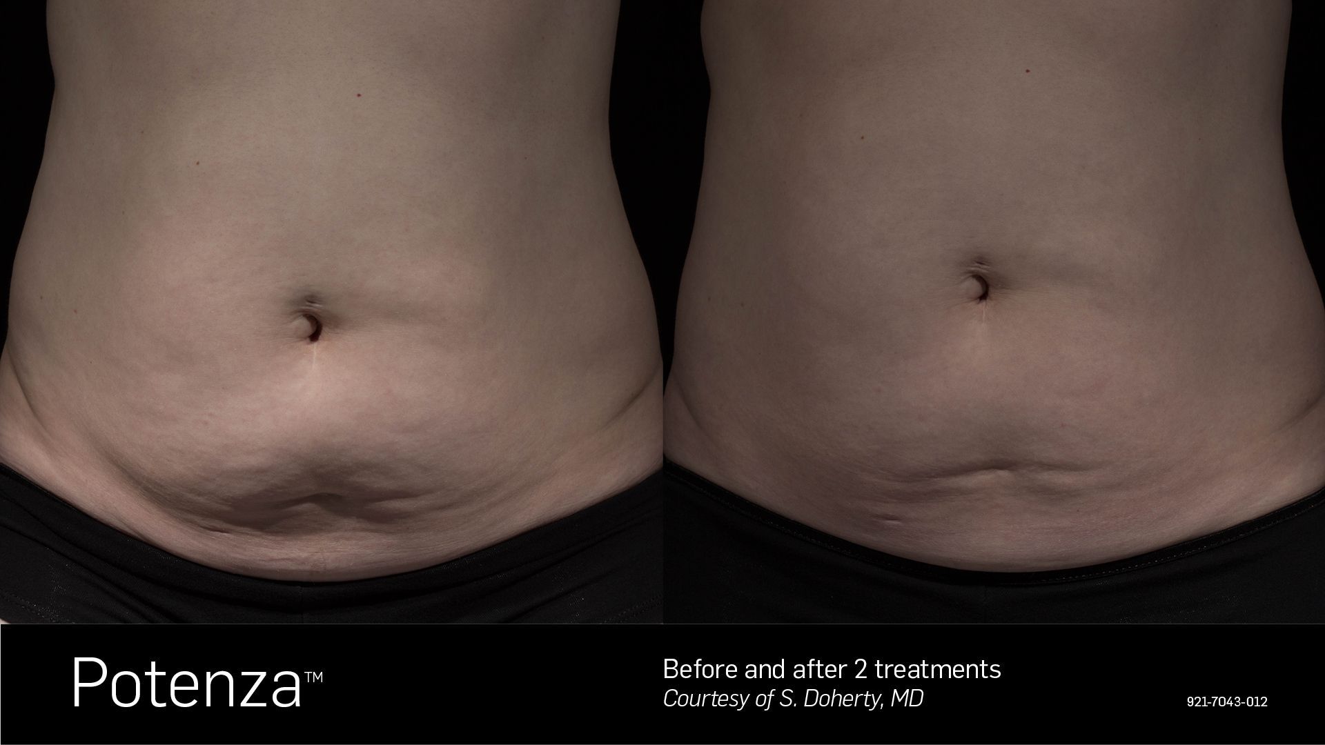 Before and after comparison of a stomach area following two Potenza radiofrequency microneedling treatments.