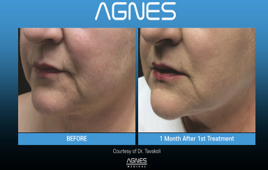 Before and after comparison of a patient's lower face showing results one month after an Agnes RF treatment.