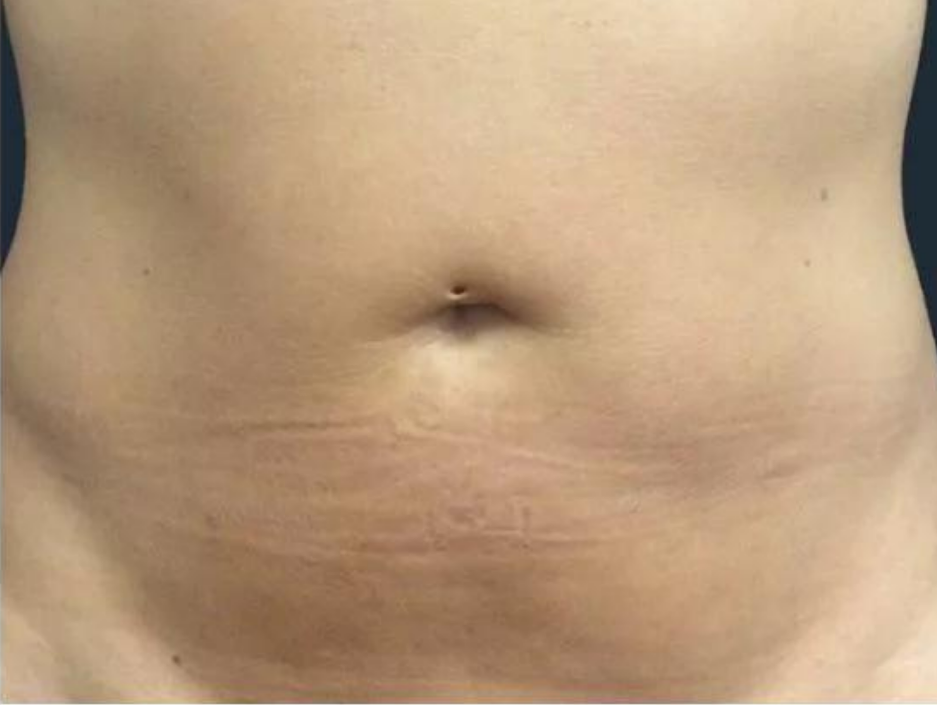 A person's lower abdomen showing visible stretch marks below the navel on fair skin.
