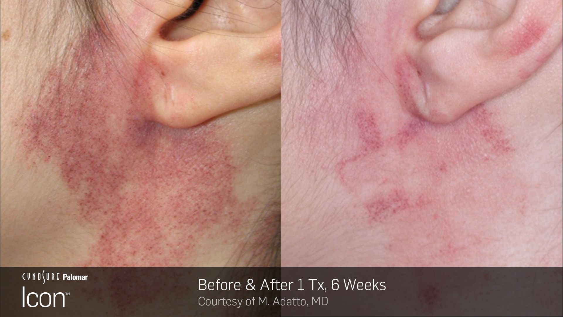 Before and after comparison of a reddish skin mark on the side of a neck, showing fading after one laser treatment.