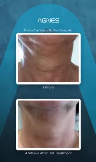 Before and after comparison of a person's neck after one Agnes skin treatment, showing a reduction in skin laxity.