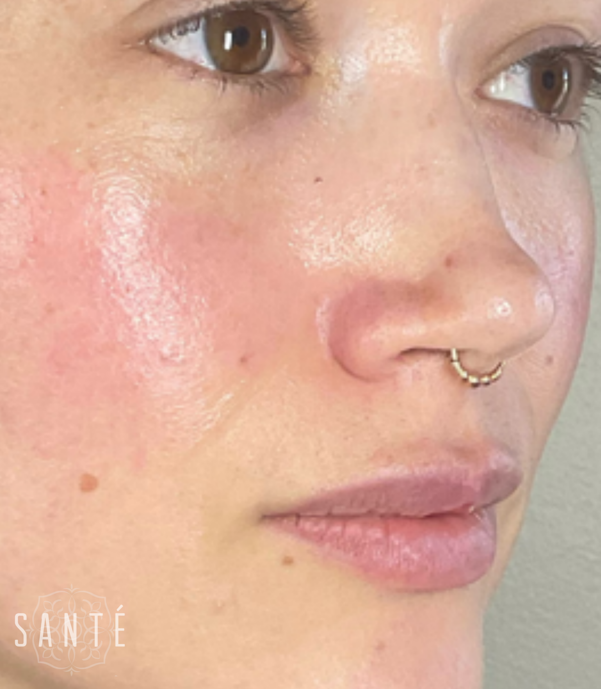 Close-up of a face showing redness on the cheeks and nose, with a gold septum ring.