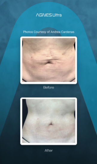 Before and after photos of a person's abdomen showing results from an Agnes Ultra skin tightening procedure.
