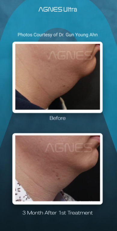 Before and after photos of a jawline treated with Agnes Ultra, showing a reduction in fat under the chin.