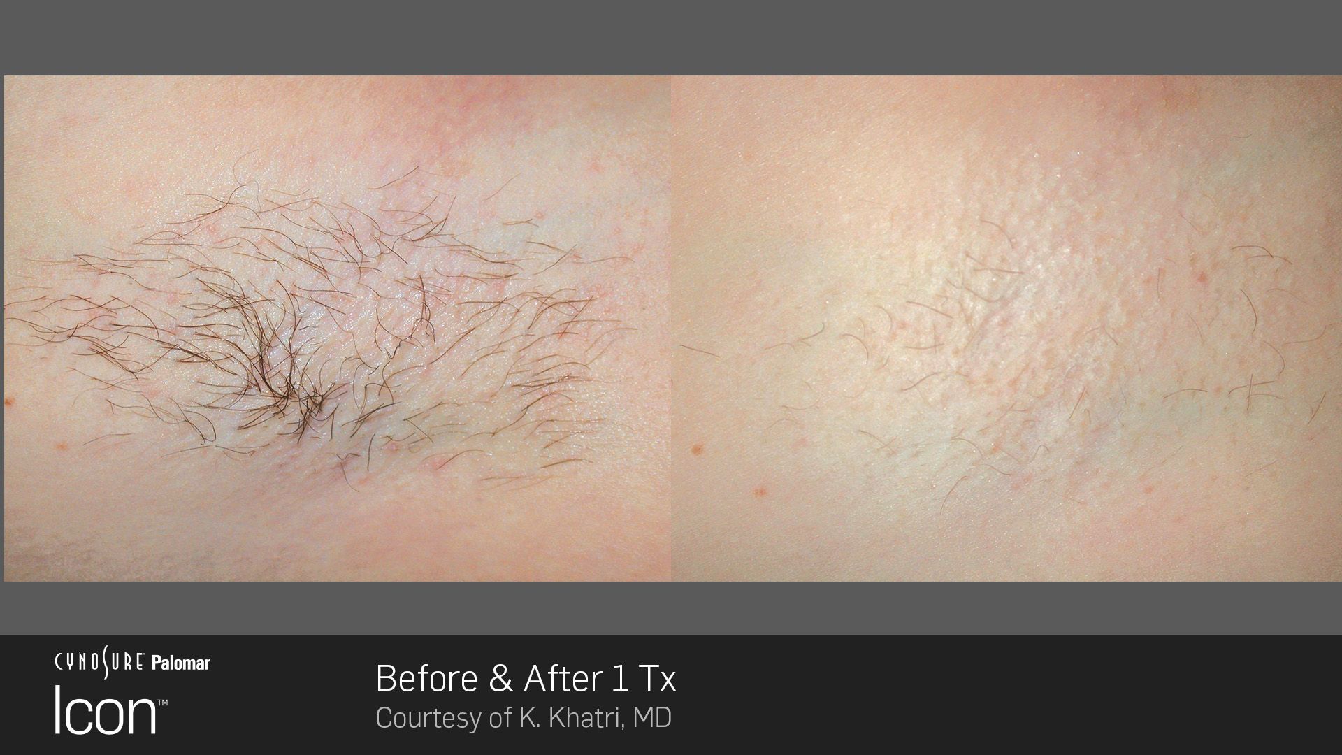 Before and after comparison of skin showing significant reduction of spider veins after one laser treatment.