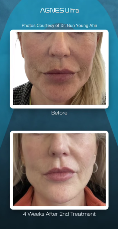 Before and after comparison of a patient's lower face showing results four weeks after a second Agnes Ultra treatment.