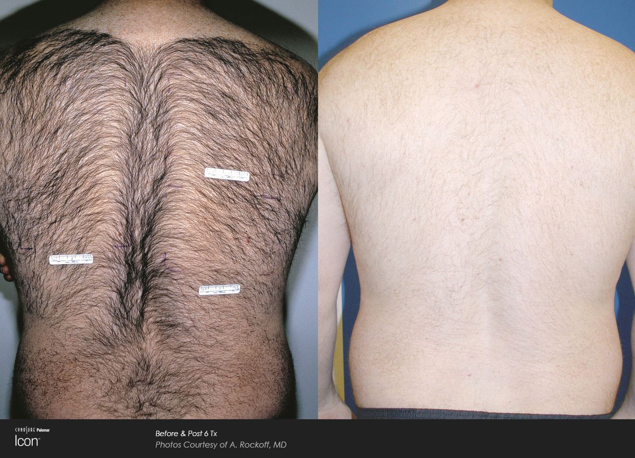 A before and after comparison of a person's back, showing significant hair reduction after laser hair removal treatment.