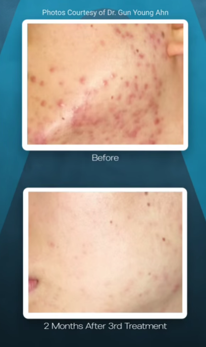 Before-and-after photos of facial skin showing a reduction in acne and redness after three clinical treatments.